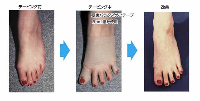 外反母趾を足裏バランステーピング法で治療した例をご紹介しています。