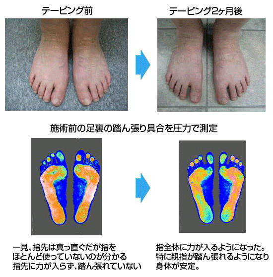 笠原先生の外反母趾治療で痛みを改善された相良京子様の足。