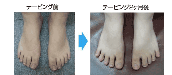 笠原先生の外反母趾治療で痛みを改善された鈴木美香様の足。